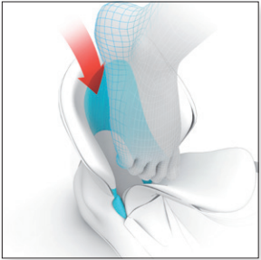 Slide-In Fabric