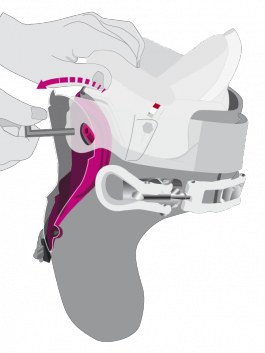 Cuff Volume Expansion